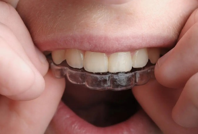 Rêve de redresser tes dents : 16 Interprétations et Symboles