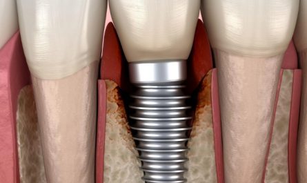Rêvez d’implants dentaires : 18 Interprétations et Symboles