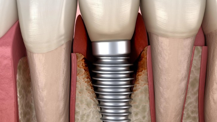 Rêvez d’implants dentaires : 18 Interprétations et Symboles