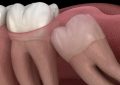 Rêvez de dents de sagesse : 16 Interprétations et Symboles