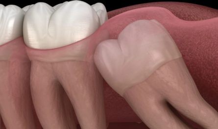 Rêvez de dents de sagesse : 16 Interprétations et Symboles