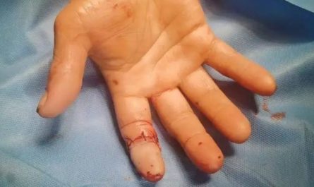 Rêver de doigts cassés : 24 Interprétations et Symboles