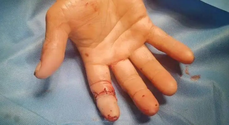 Rêver de doigts cassés : 24 Interprétations et Symboles