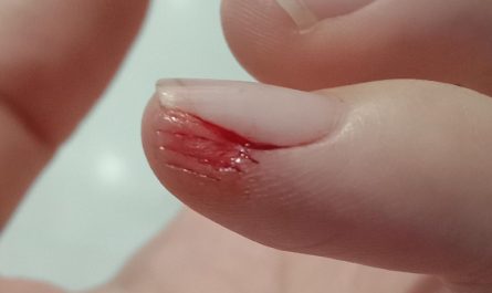 Rêver de mains blessées : 22 Interprétations et Symboles