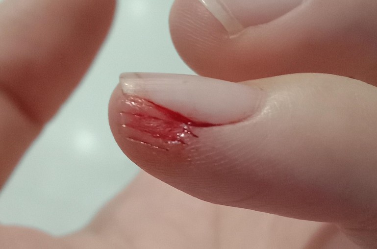 Rêver de mains blessées : 22 Interprétations et Symboles