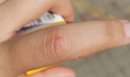 Rêver de blessure au doigt : 28 Interprétations et Symboles