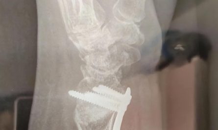 Rêver de poignet cassé : 16 Interprétations et Symboles