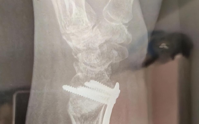 Rêver de poignet cassé : 16 Interprétations et Symboles