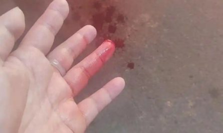 Rêver de te faire couper les doigts : 30 Interprétations et Symboles