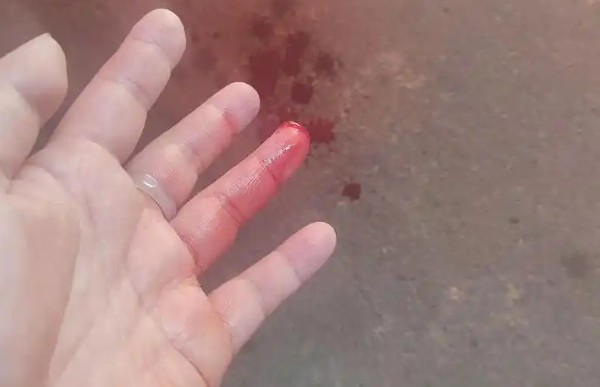 Rêver de te faire couper les doigts : 30 Interprétations et Symboles