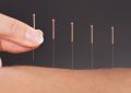 Rêver d'une clinique d'acupuncture : 21 Interprétations et Symboles
